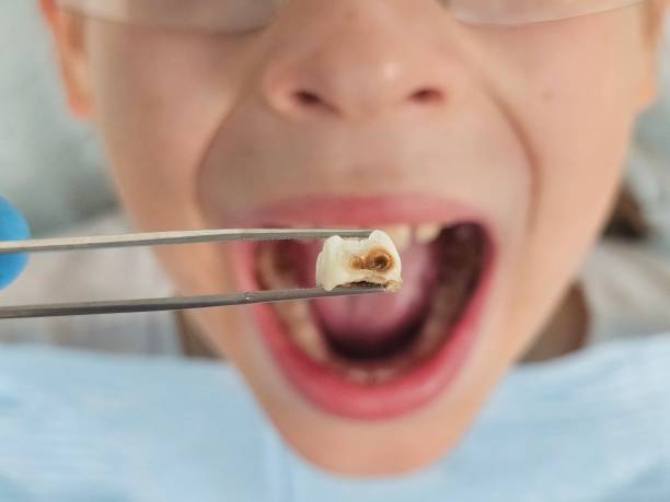 Best Emergency Tooth Extraction in Enoch, UT