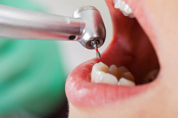 Best Emergency Tooth Extraction in Enoch, UT